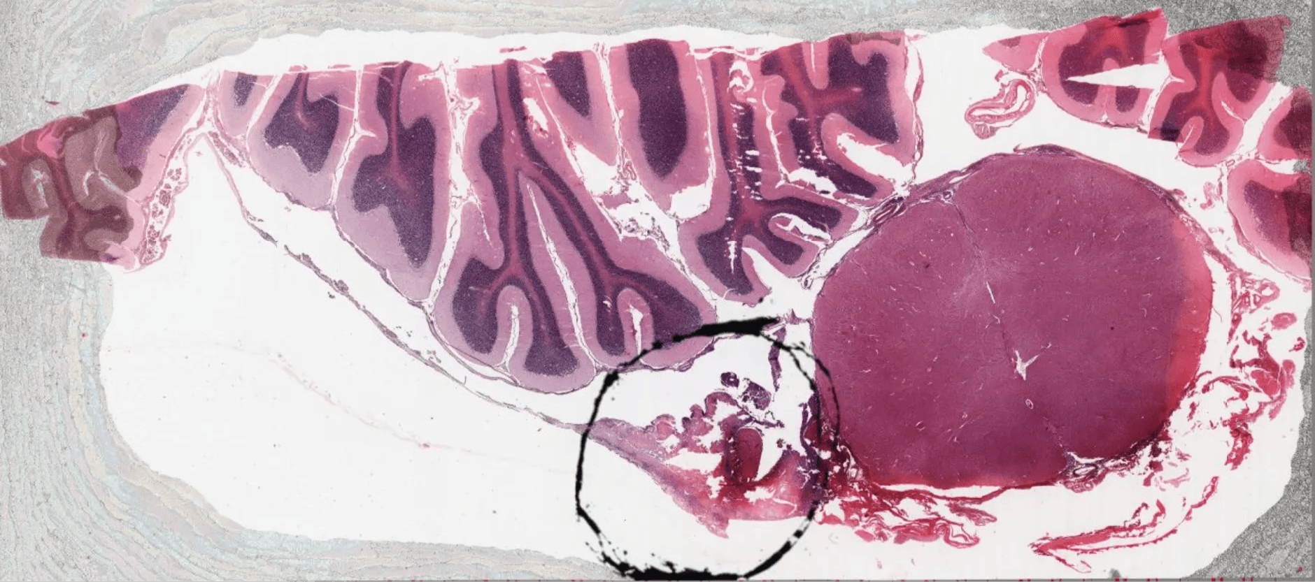 Low resolution pathology slide of brain tissue from a patient with coccidiodal meningitis