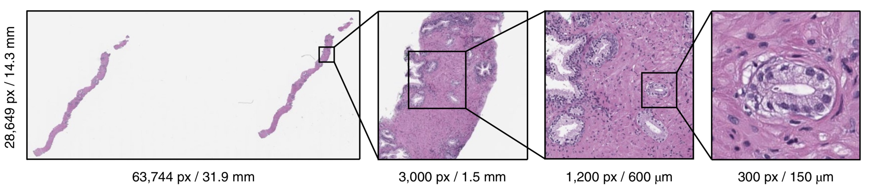 A gigapixel whole slide pathology image of a prostate biopsy with progressive zoom levels showing how a small cluster of cancerous glands occupies less than 1% of the total tissue area